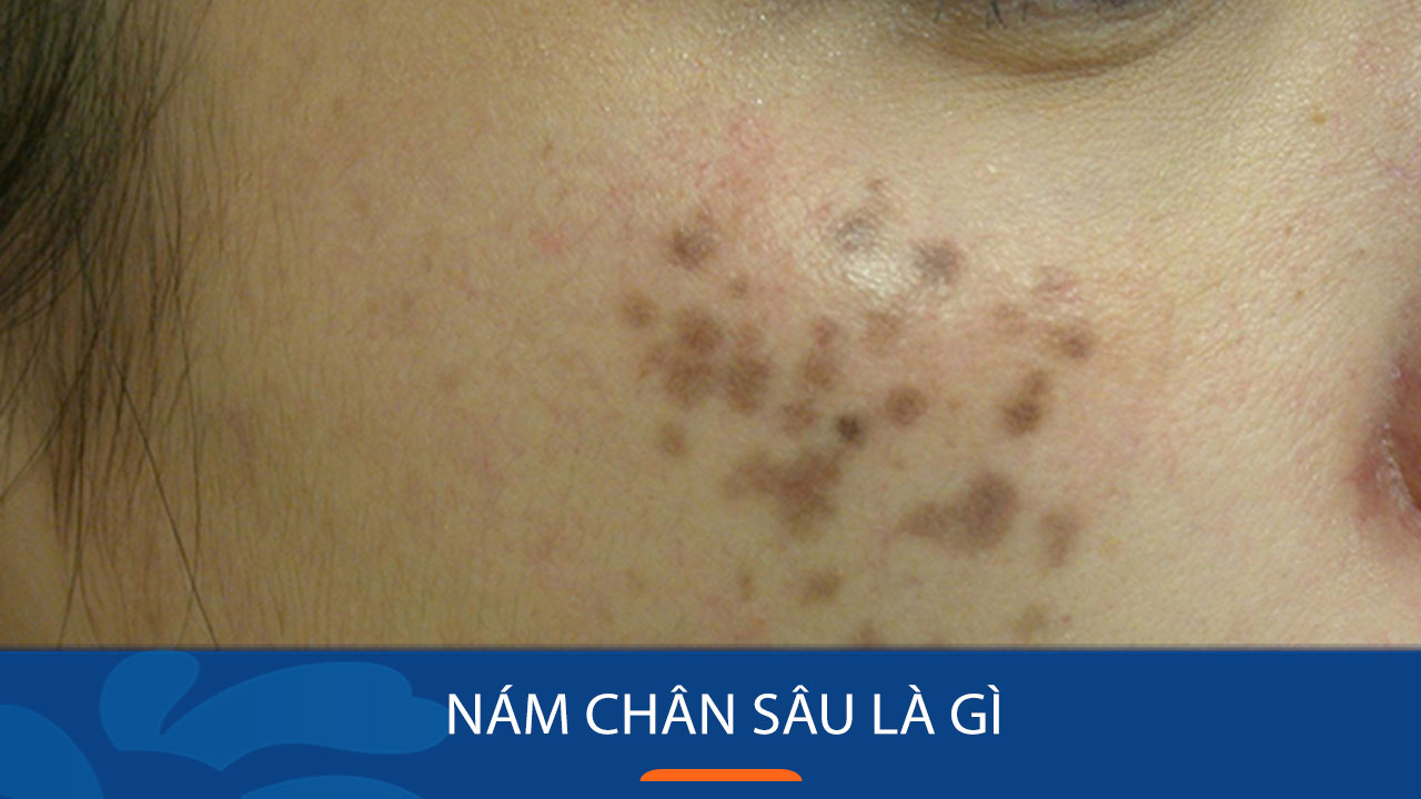 Kem trị nám chân sâu tại nhà