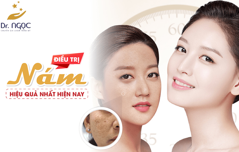 Phương pháp điều trị nám nào tốt nhất