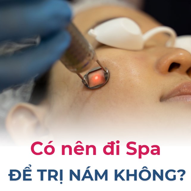 Spa trị nám ? Top 5 Lợi ích khi trị nám tại spa