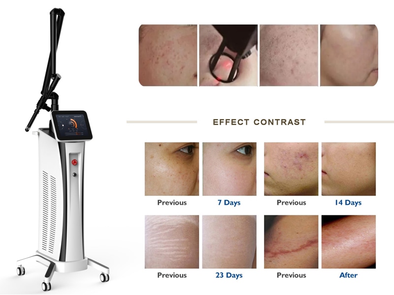 Trẻ hóa âm đạo bằng laser co2 fractional