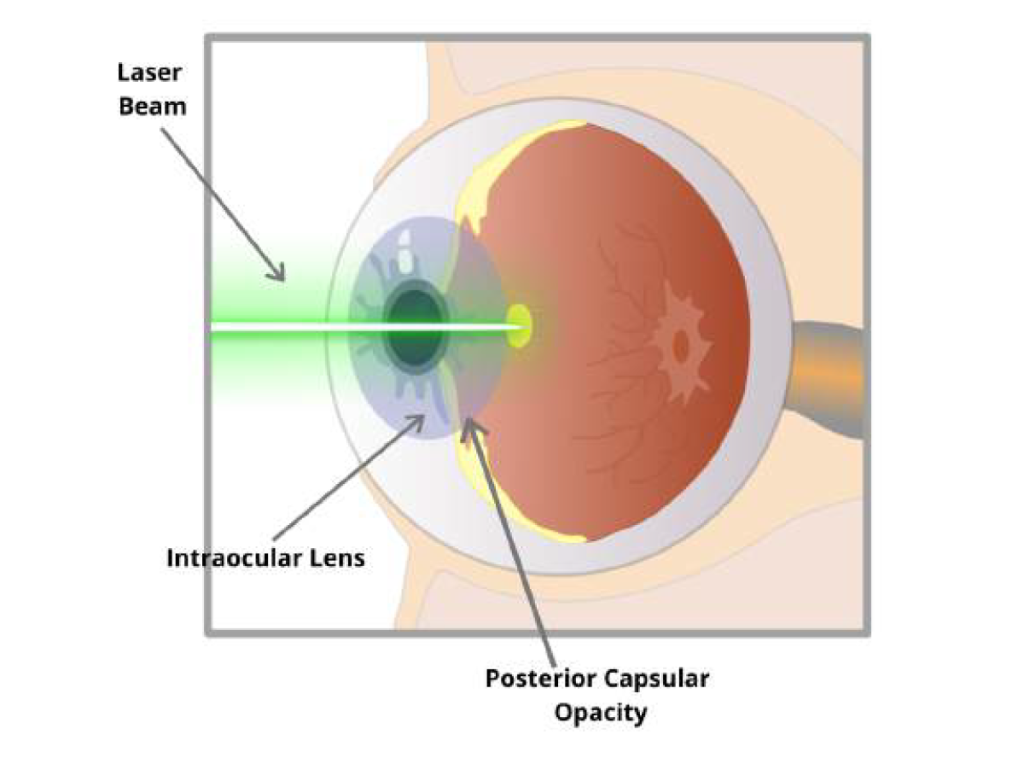 Yag laser Công nghệ Tiên tiến trong Y tế