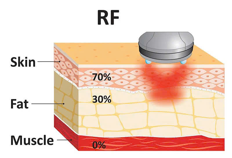 công nghệ RF