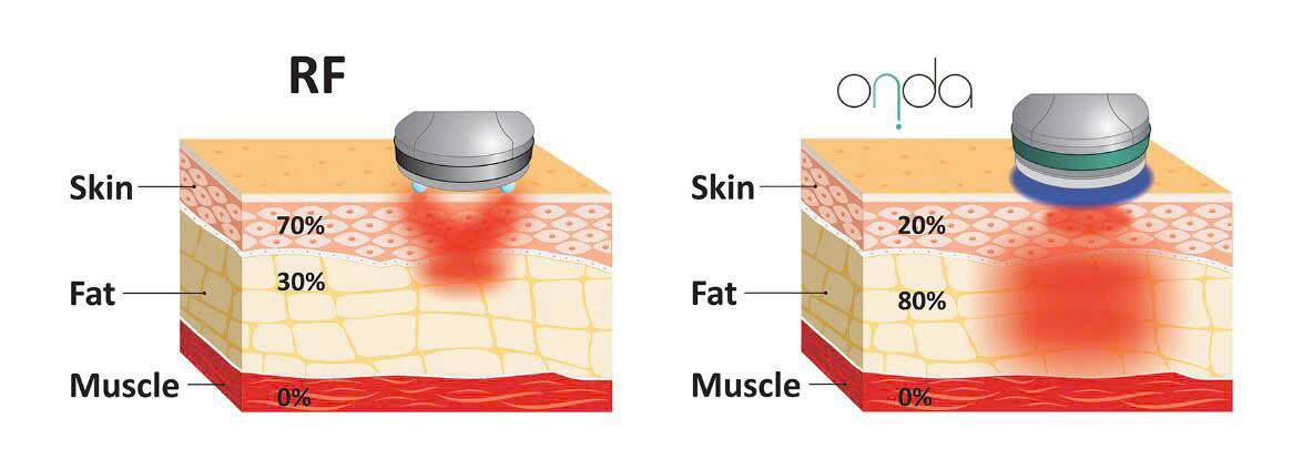 công nghệ RF và Onda Coolwaves
