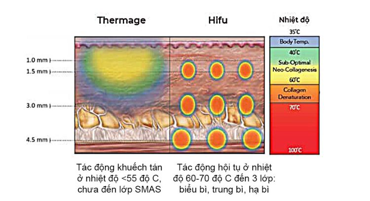 so sánh công nghệ hifu và thermage