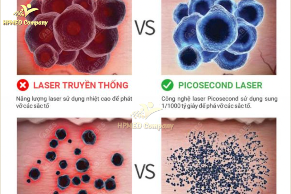 công nghệ Laser Picoseconds