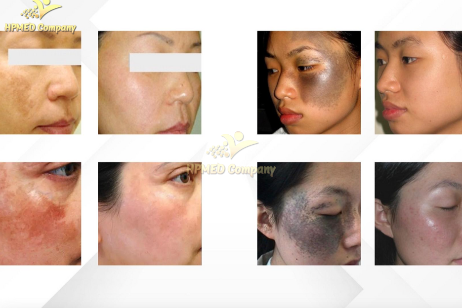 công nghệ Laser Picoseconds
