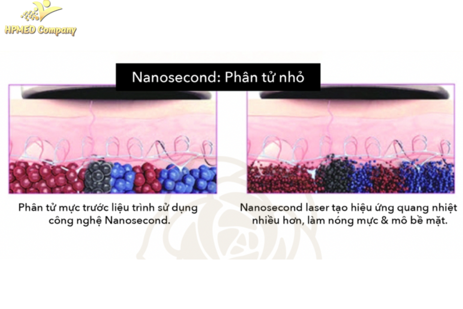Laser Nanosecond (Q-Switched ND:YAG)