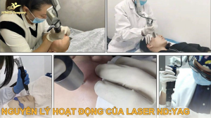 Nguyên lý hoạt động của laser nd yag ?