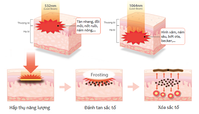 nguyên lý hoạt động của laser nd yag