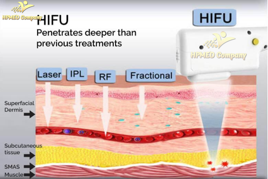 Nguyên lý hoạt động của máy HIFU 7D