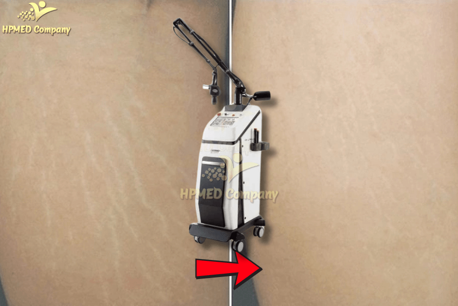 Laser CO2 Fractional Trị Rạn Da