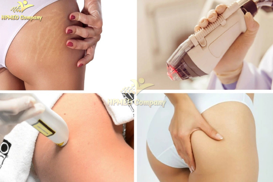 Hiệu Quả Sau Sử Dụng Máy Trị Rạn Da 