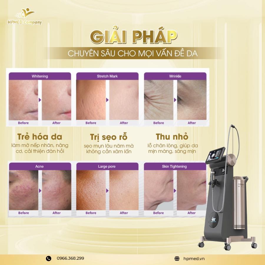 Máy Rf Vi Kim Pinacle Hàn Quốc