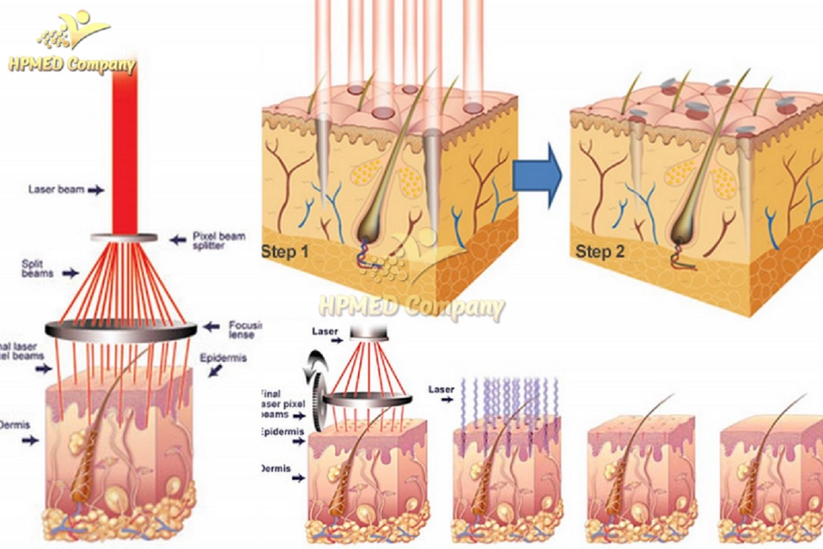 Cơ chế hoạt động của Máy Laser CO2 Fractional lên bề mặt da