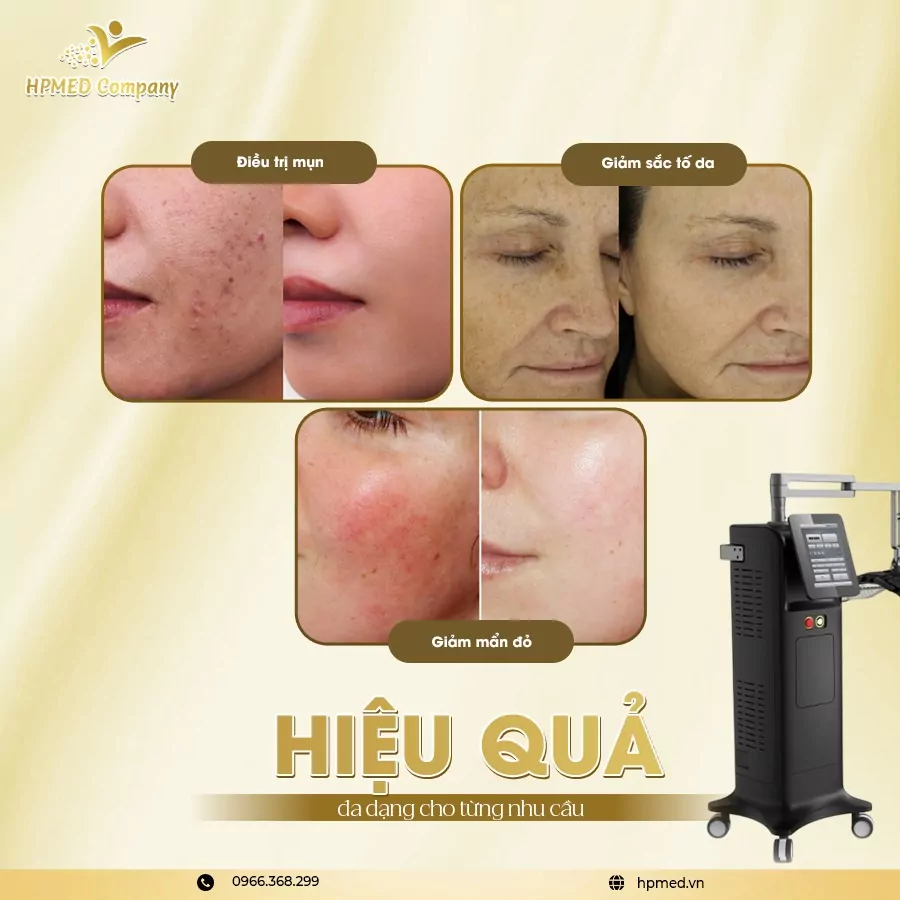 Máy Ánh Sáng Sinh Học PDT ADSS Chính Hãng Cho Spa, Clinic 5 Máy Ánh Sáng Sinh Học PDT ADSS