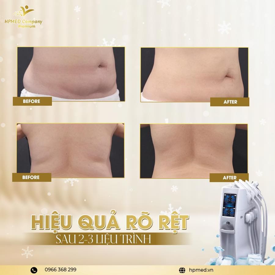 Máy Giảm Béo Quang Đông CoolShaping 2 Cao Câp Hàn Quốc