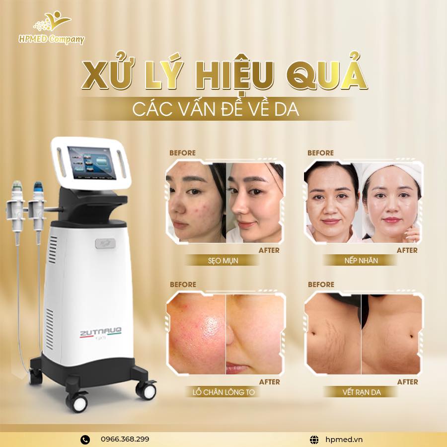 Máy Trị Sẹo Rf Vi Điểm Quantus Bắc Kinh