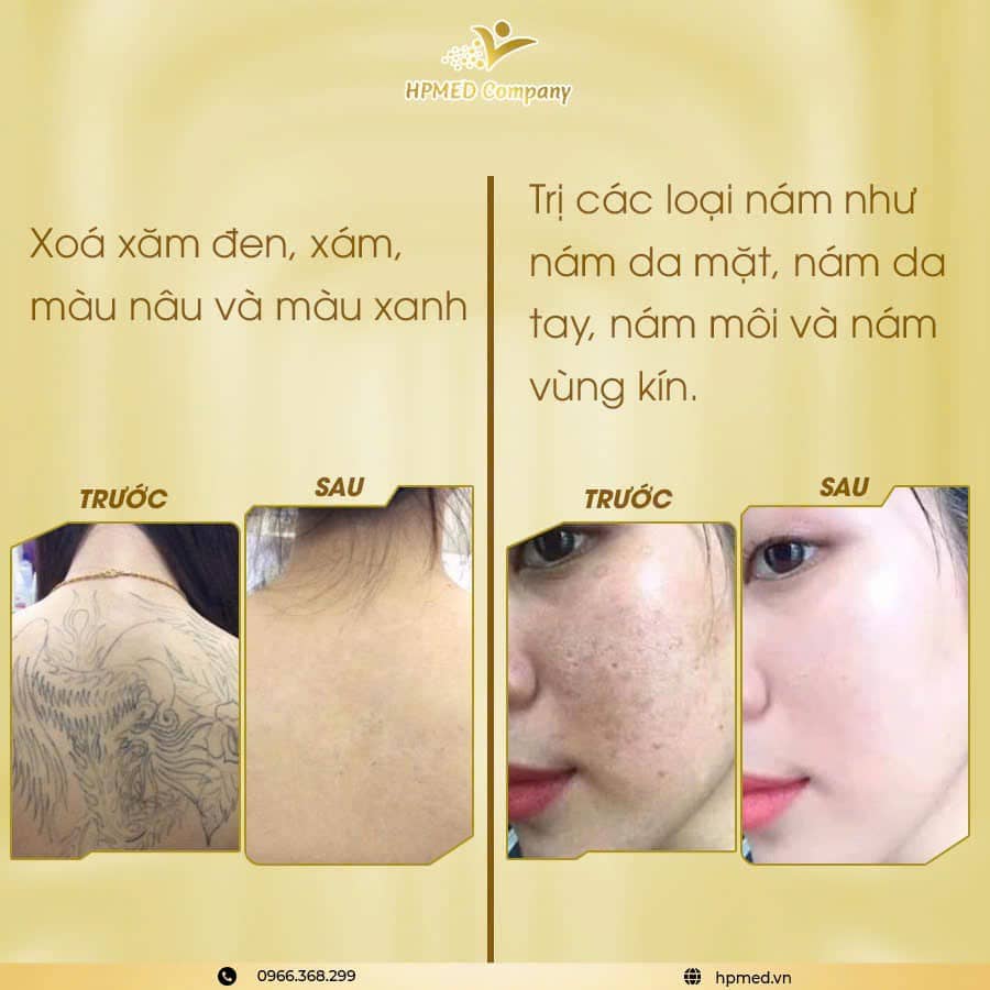máy trị nám laser