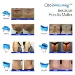 Máy Giảm Béo Quang Đông 360 Cryolipolysis 💎 Giải Pháp Làm Gọn Vóc Dáng An Toàn Cho Spa Hiện Đại