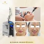 Máy Laser ND YAG Q-Switch SL-NY 602 Xóa Xăm Trị Nám