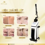 Máy Laser CO2 Fractional Pentagon Glass F Bóng Thủy Tinh Hàn Quốc ⭐ Ultra Pulse 20W – Chuẩn Điều Trị Sẹo & Trẻ Hóa Da