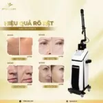 Máy Laser CO2 Fractional Pentagon Glass F Bóng Thủy Tinh Hàn Quốc ⭐ Ultra Pulse 20W – Chuẩn Điều Trị Sẹo & Trẻ Hóa Da