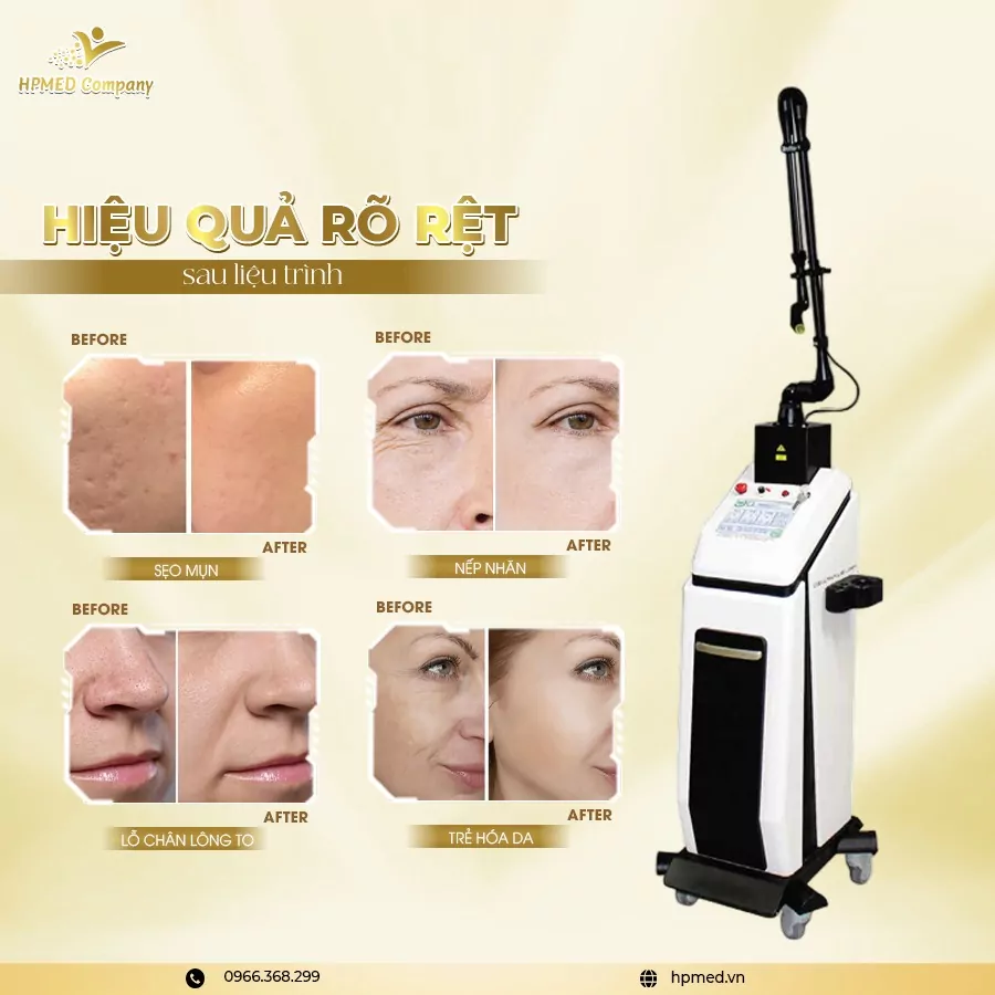 Máy Laser CO2 Fractional Pentagon Glass F Bóng Thủy Tinh Hàn Quốc ⭐ Ultra Pulse 20W – Chuẩn Điều Trị Sẹo & Trẻ Hóa Da