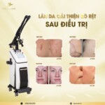 Máy Laser CO2 Fractional Pentagon GRAND Bóng Hợp Kim RF ⭐ Chuẩn Trị Sẹo & Tái Tạo Da Chuyên Sâu Hàn Quốc