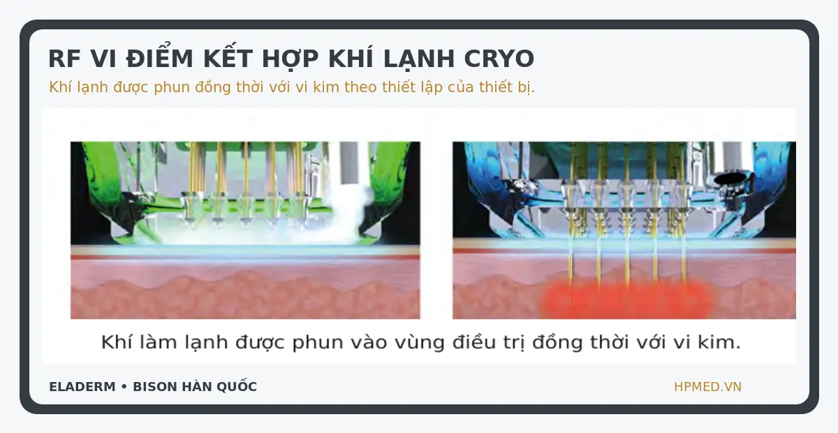 Cơ chế RF vi điểm kết hợp khí lạnh Cryo của máy ElaDerm