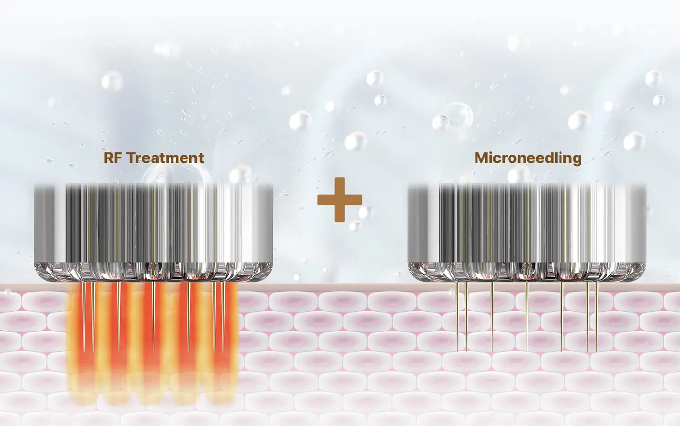 Cơ chế RF bipolar kết hợp vi kim của RM STAR MD