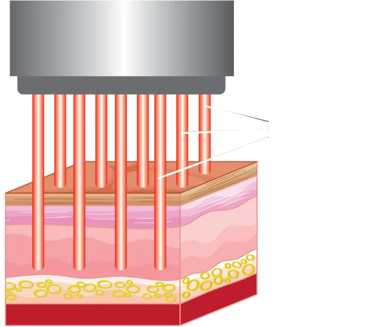 Nguyên lý vi chùm tia laser CO2 fractional – IDS Sơ đồ IDS minh họa các vi chùm tia laser fractional tác động trên mô da