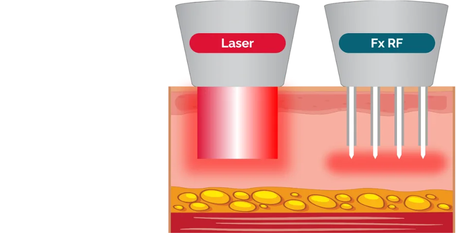 Sơ đồ IDS minh họa laser và RF fractional vi điểm tại lớp biểu bì và trung bì