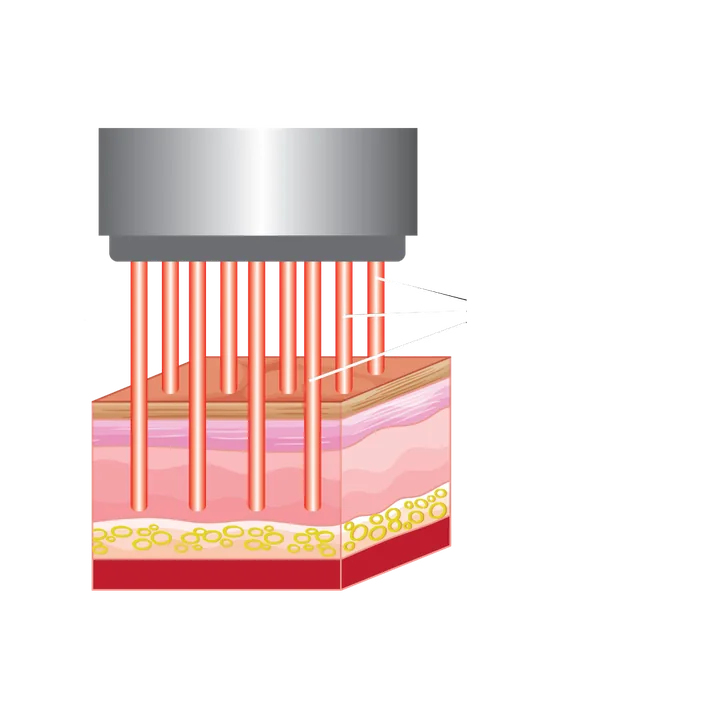 Sơ đồ các vi tia laser fractional tác động lên mô da do IDS Korea công bố