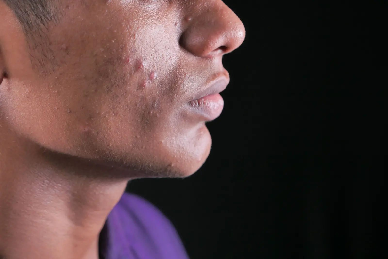 FDA Clears 1726nm Laser Acne Vulgaris Treatment
