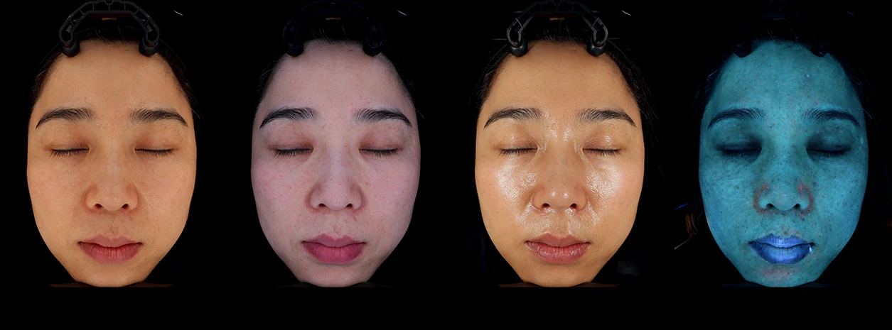 Ảnh khuôn mặt do PIE minh họa dưới ánh sáng thường, phân cực chéo, phân cực song song và UV trên JANUS Pro Hybrid