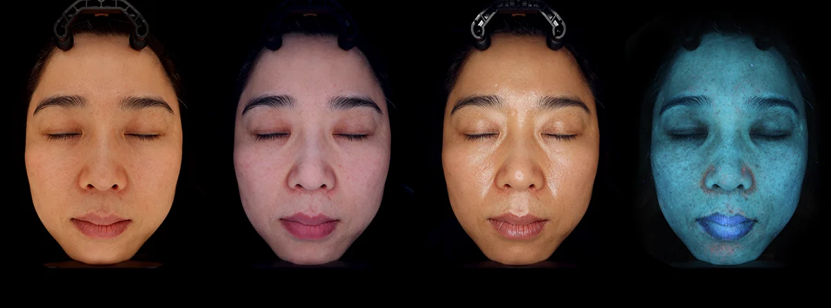 Ảnh khuôn mặt chụp bằng ánh sáng thường, phân cực chéo, phân cực song song và UV của JANUS Pro Sunlike
